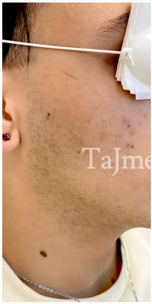 Voor: acne op de kaaklijn