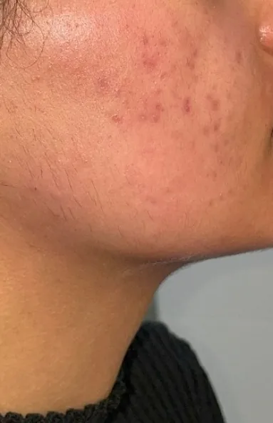 Voor: wang met actieve acne